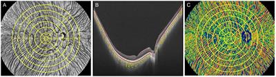 Regional assessment of choroidal vascularity index in patients with pre- and early-stage diabetic retinopathy using ultra-wide-field OCTA